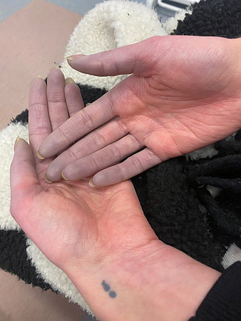 close up of hands showing Secondary Raynaud’s